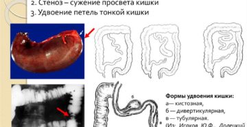 Аномалии и пороки развития тонкой кишки