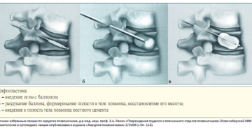 компрессионный перелом 12 позвонка 1 степени