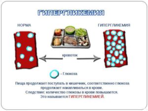 Гипергликемия и сахарный диабет