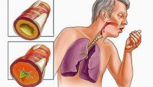 Что делать при болях за грудиной после гриппа и острого бронхита?