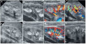 синдром гиперэхогенных пирамидок