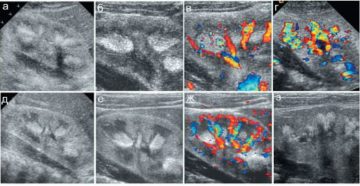 синдром гиперэхогенных пирамидок
