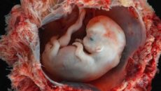 Осложнения I триместра беременности: Самопроизвольный аборт