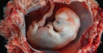 Осложнения I триместра беременности: Самопроизвольный аборт